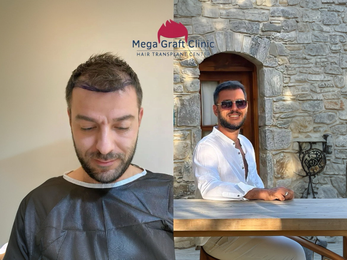 Before and after hair transplant result 2
