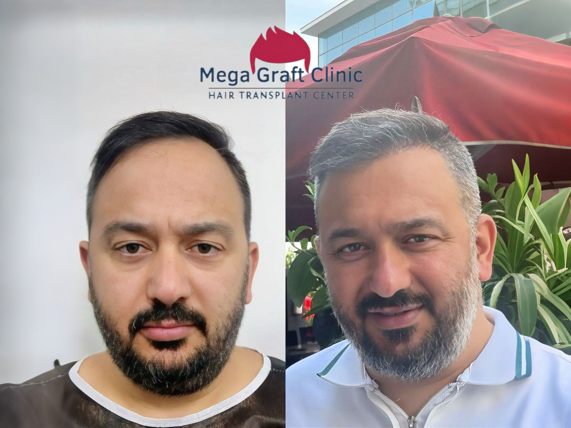 Before and after hair transplant result 3
