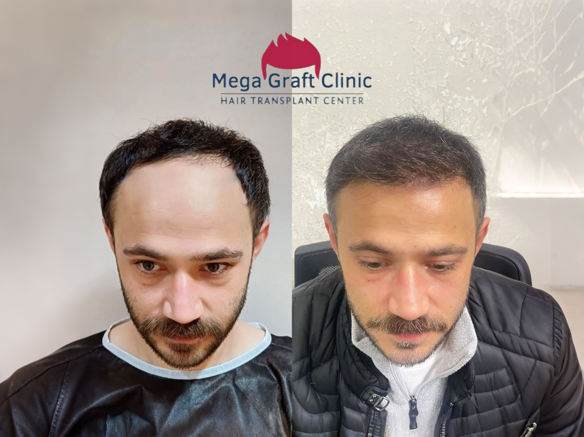 Before and after hair transplant result 4