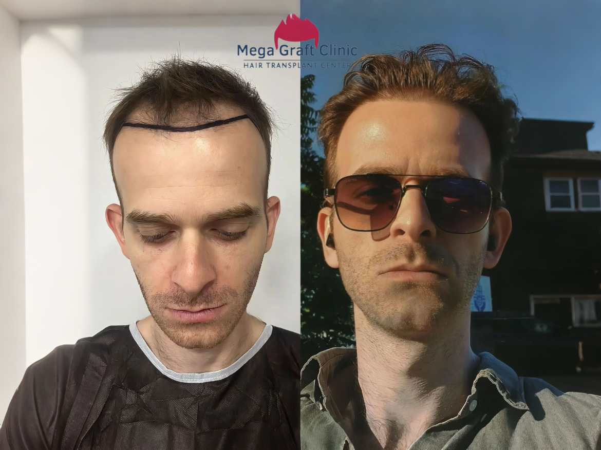 Before and after hair transplant result 6