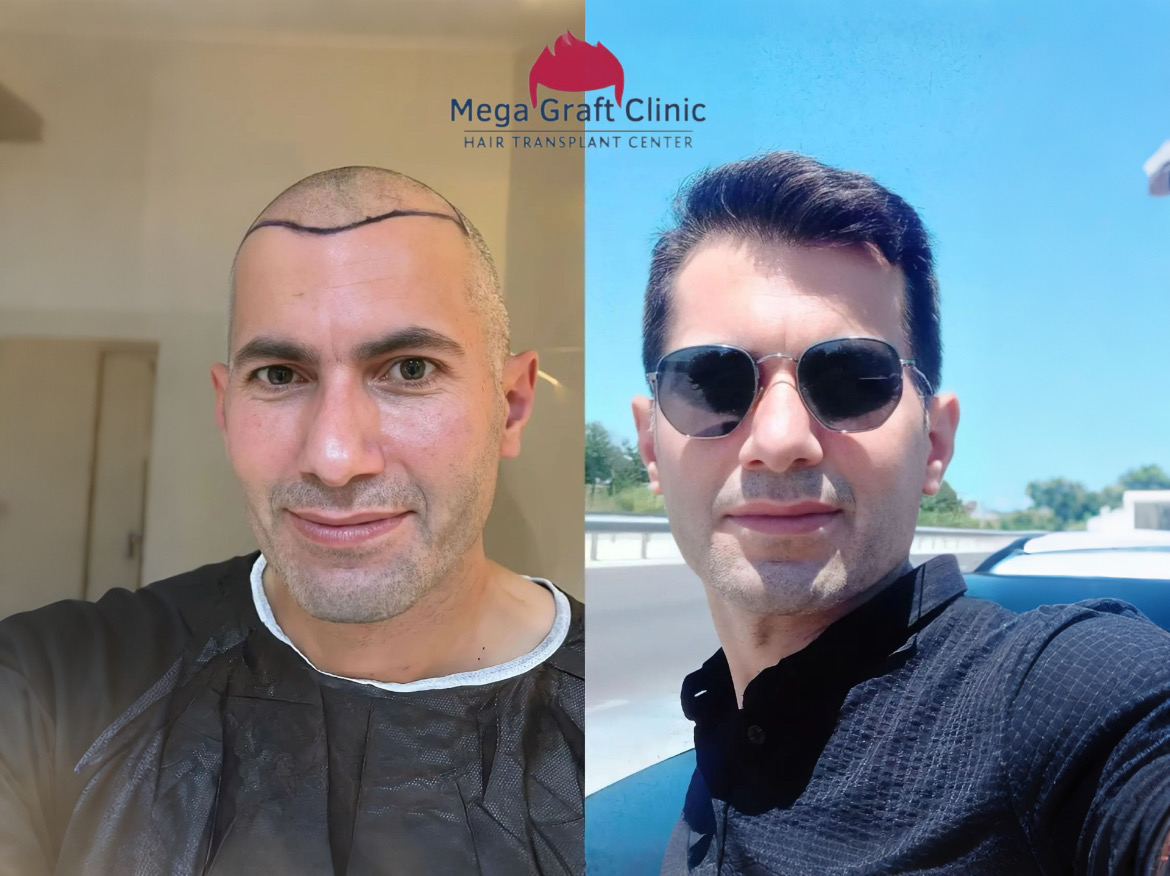 Before and after hair transplant result 7