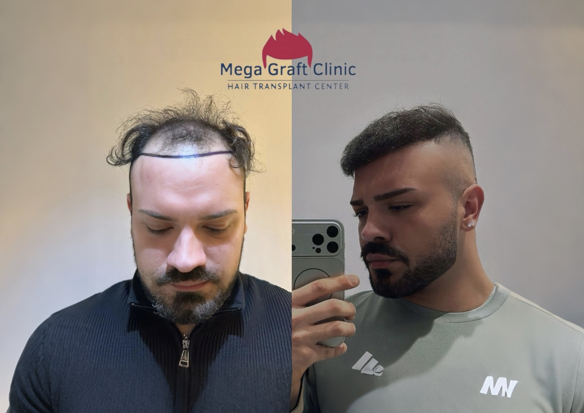 Before and after hair transplant result 8