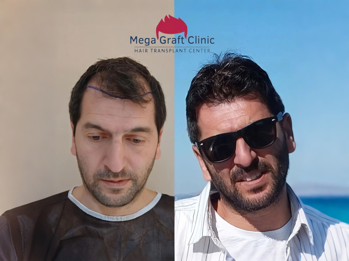 Before and after hair transplant result 9