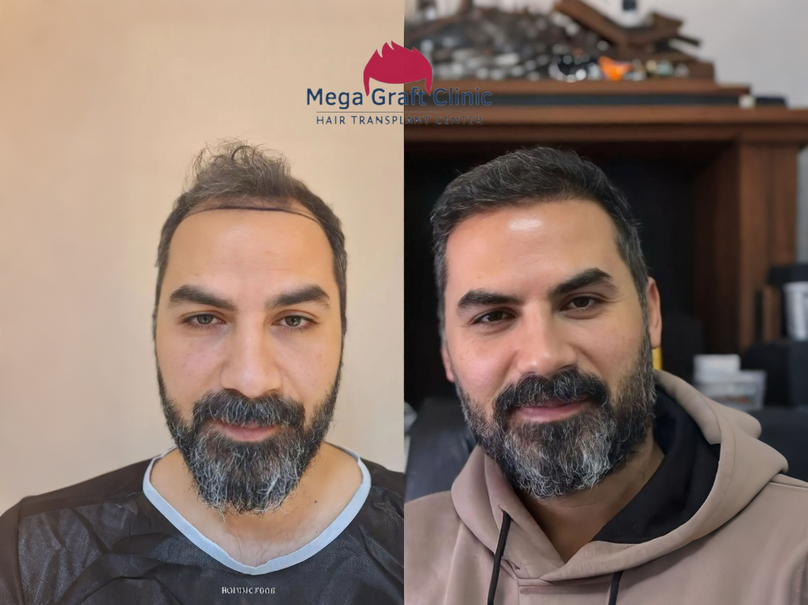 Before and after hair transplant result 10