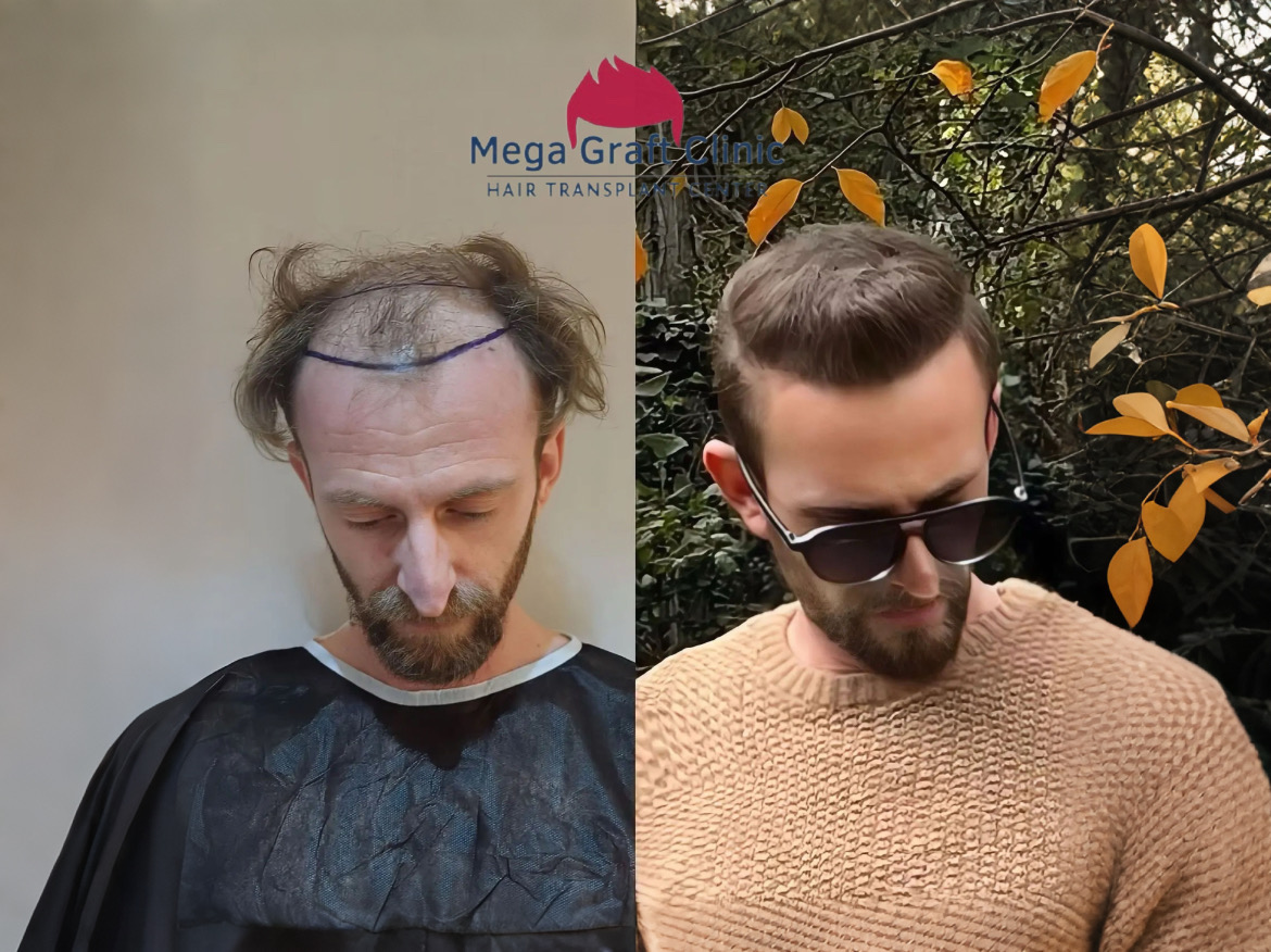 Before and after hair transplant result 11